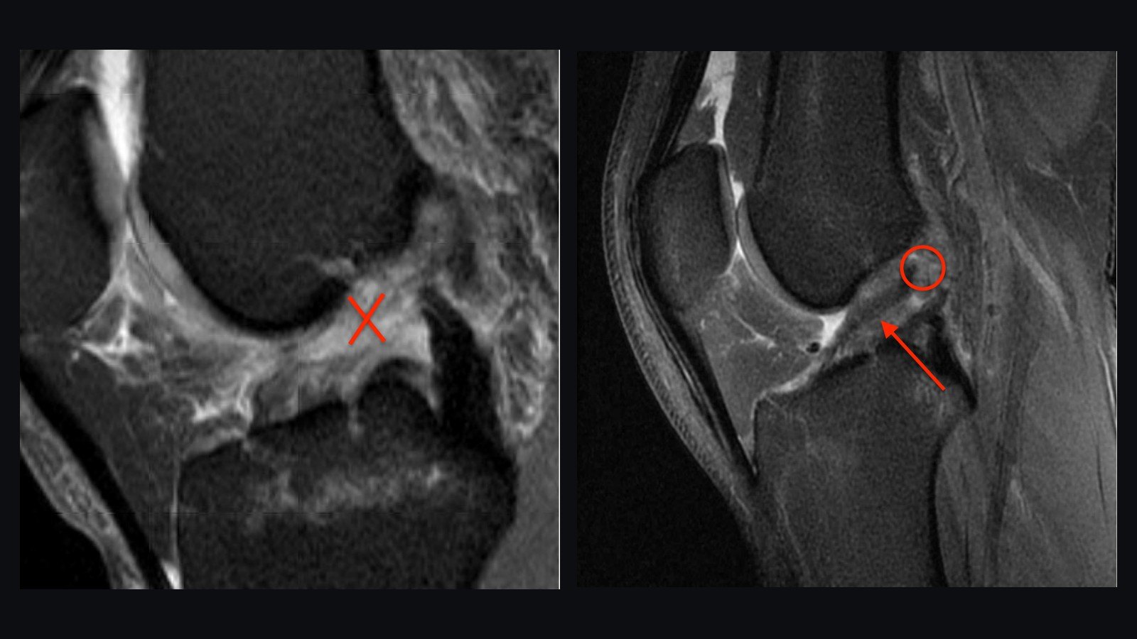 Two knee MRIs side by side: one ACL with no usable fibers left, and one with healthy ACL tissue still attached to the tibia.