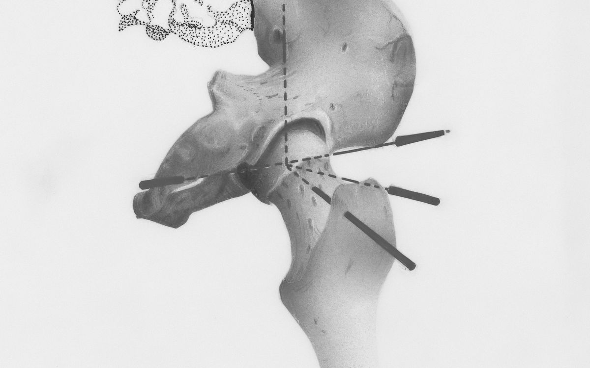 Anatomical drawing of the hip joint and upper thigh bone.