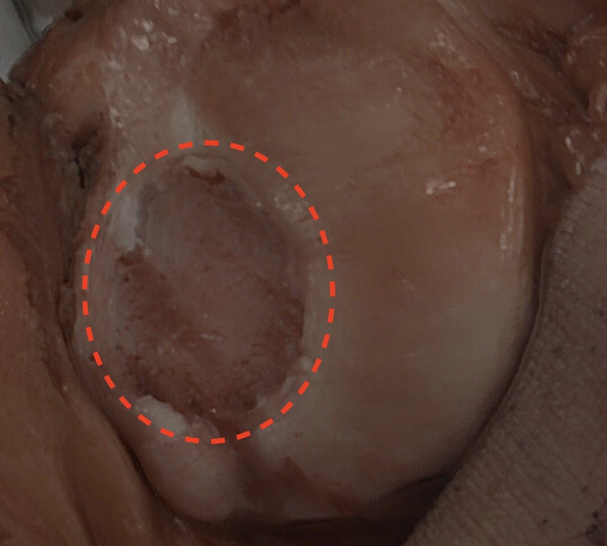 The defect. The dashed circle shows where the cartilage was knocked off the back of the kneecap, cleaned back to healthy edges before the graft goes in.