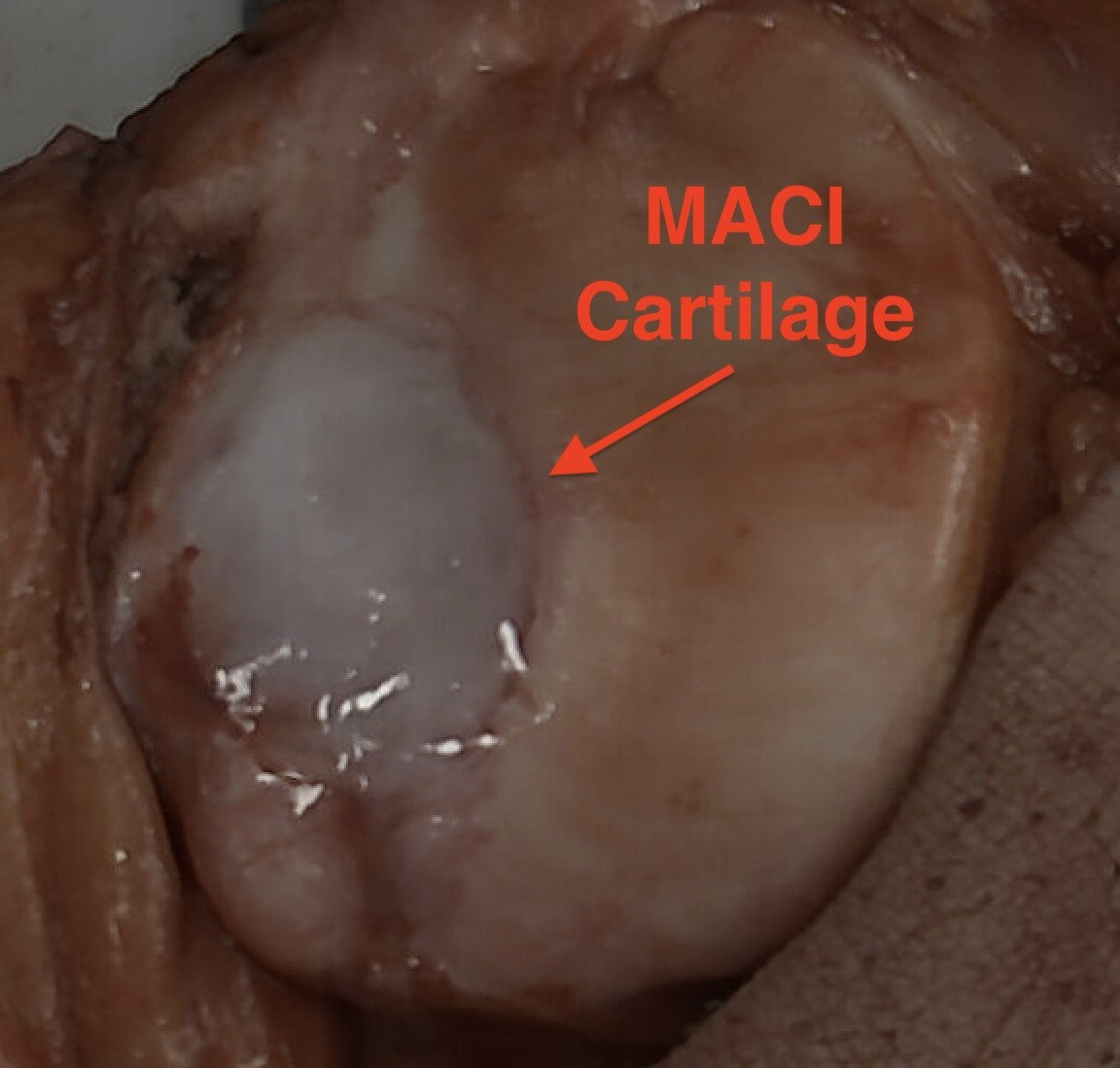 The MACI graft. The sheet of his own cartilage cells, trimmed to fit and secured into the defect, where it matures into new cartilage.