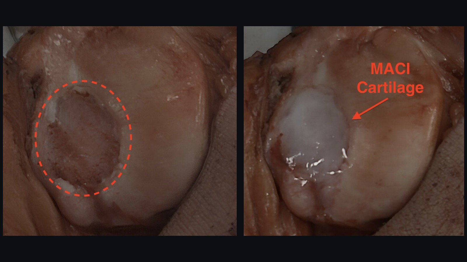 Two surgical photos of the back of the kneecap: the cartilage defect after the fragment was removed, and the same spot filled with a MACI cartilage graft.