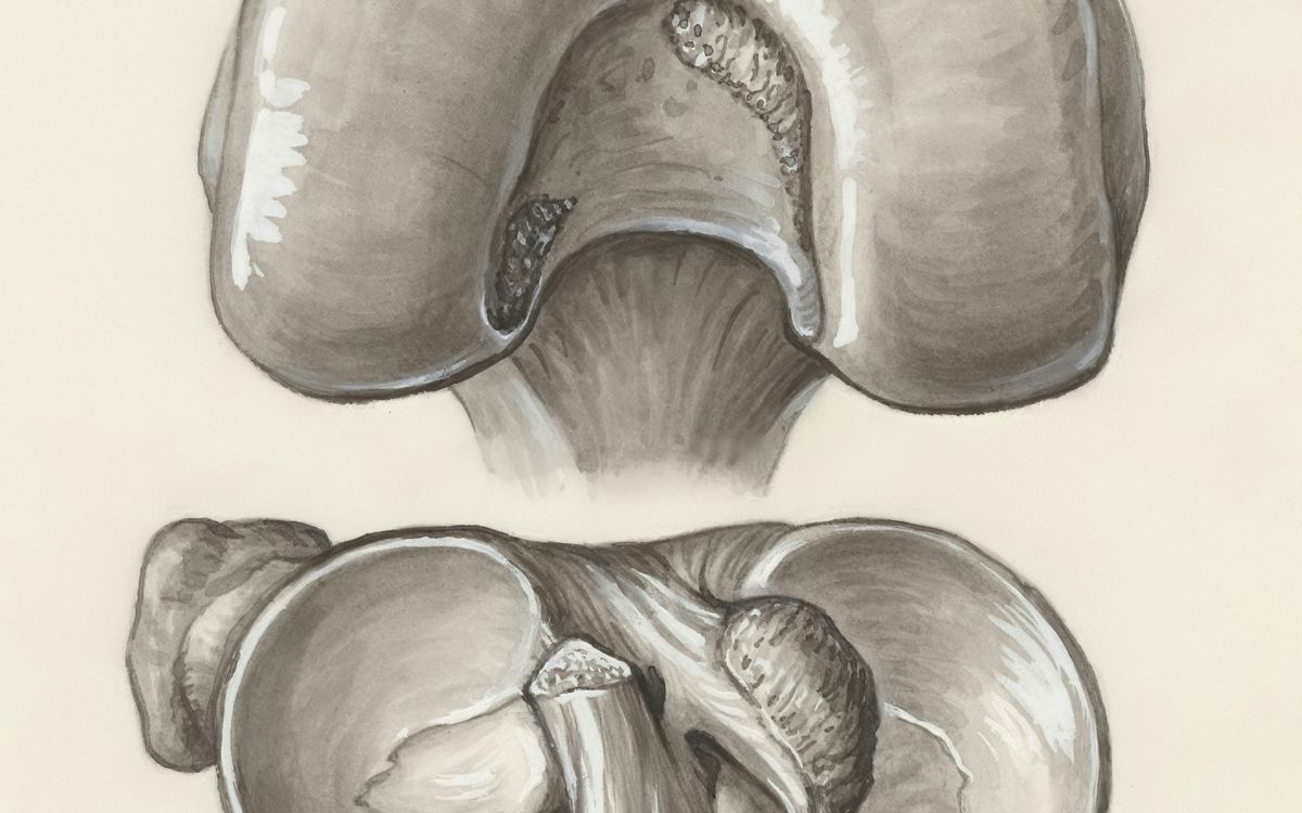 Anatomical drawing of the knee joint showing the menisci.