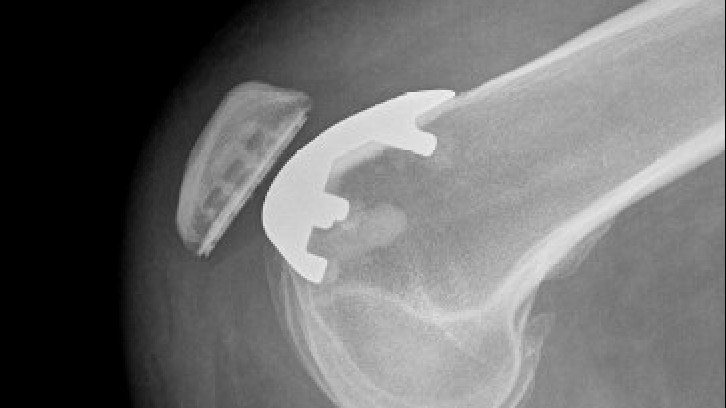 Side-view knee X-ray of a patellofemoral replacement, with a metal groove on the thigh bone and a plastic button on the back of the kneecap.