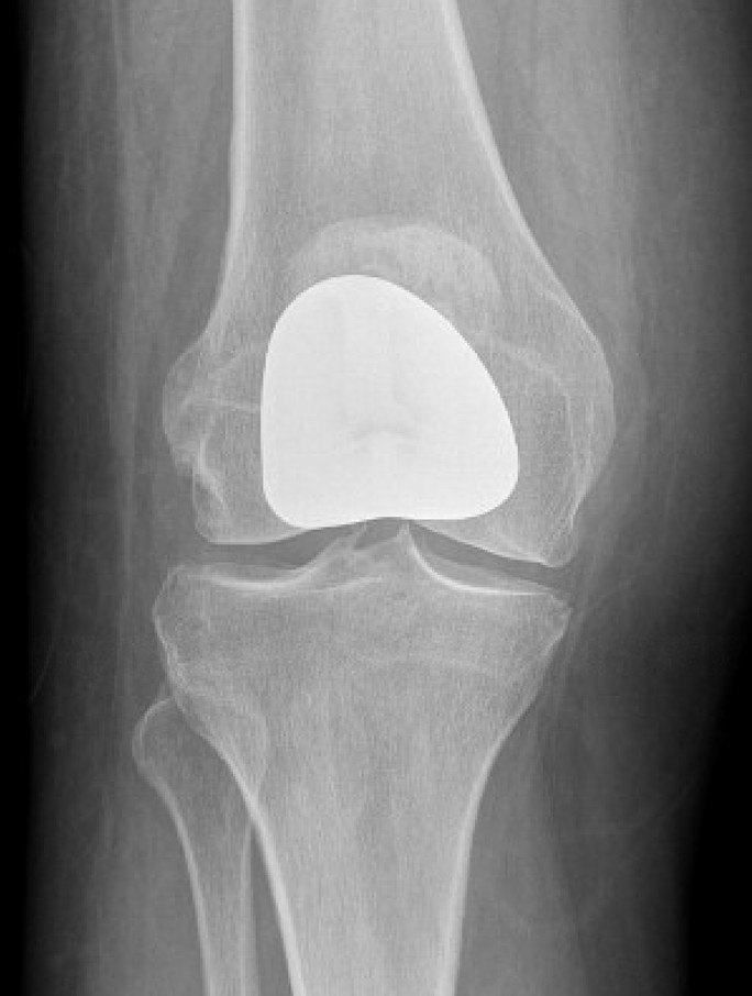 Front view. The metal component resurfaces only the groove at the end of the thigh bone. The inside and outside of the knee keep their own cartilage, and the joint spaces stay open.