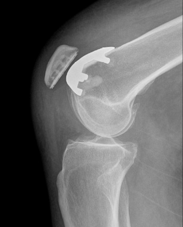 Side view. The plastic button on the back of the kneecap glides in the new metal groove. Everything else, including the ACL and other ligaments, is left alone.