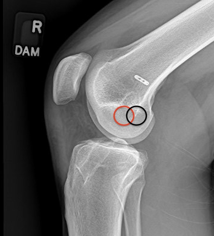 Technical. The red circle is where the original femoral tunnel was placed. The black circle is where it should be. A tunnel too far forward makes the graft too vertical, so it can't stop the tibia from sliding forward.