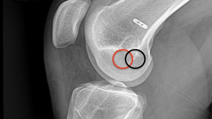 Side-view knee X-ray. A red circle marks the original femoral tunnel, too far forward; a black circle marks where it should be.