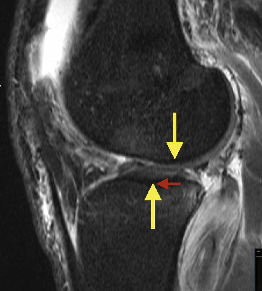 Biologic + traumatic. In a stable knee the two yellow arrows line up. Here the tibia sits forward of the femur, and the red arrow shows how far. That shift loads the menisci, which tore with the re-injury.